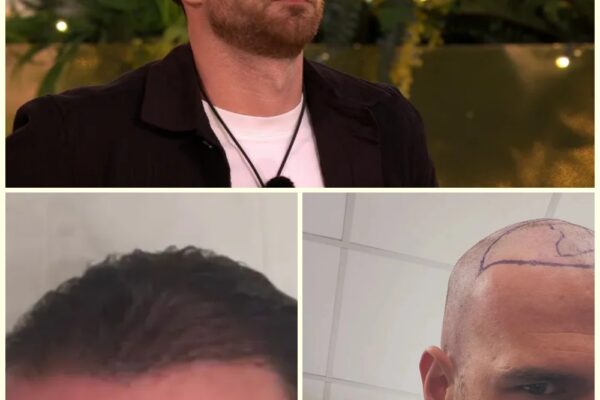 Love Island Star Ronnie Vint Unveils Dramatic Hair Transplant Before-a...